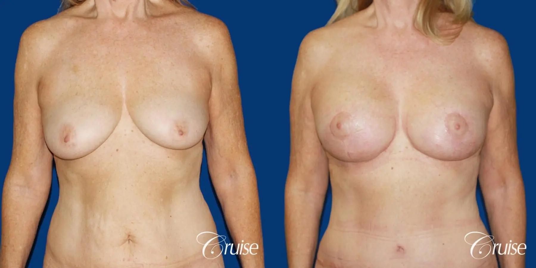 62 yr old woman with breast lift anchor and silicone implants - Before and After 1