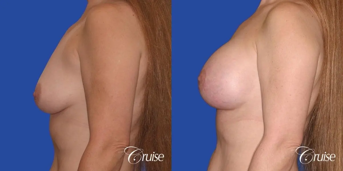 best breast lift donut scars in Newport Beach - Before and After 2