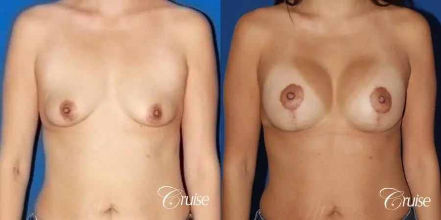 best breast lift anchor with high profile silicone 425cc - Before and After 1