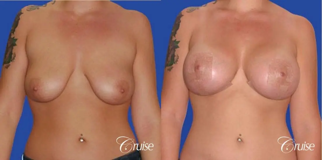 best before and after of silicone breast lift anchor in Newport Beach - Before and After 1