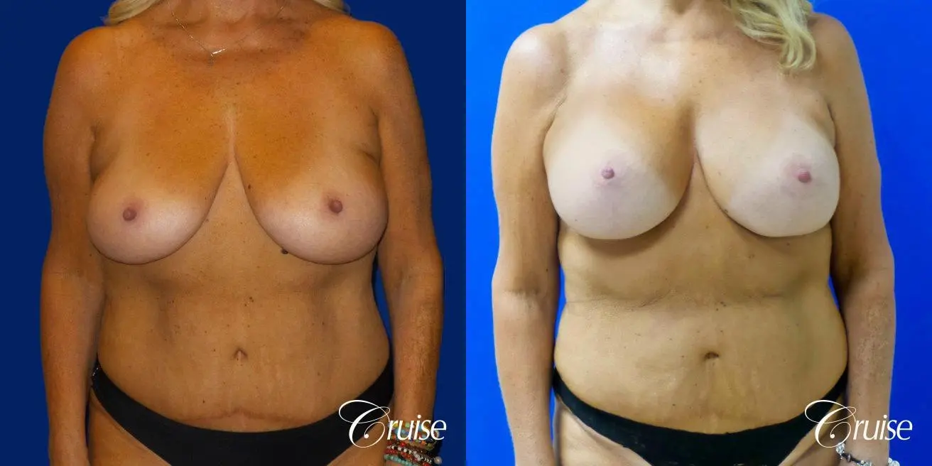 Breast Lift Anchor W/ Silicone Implants On Mature Woman - Before and After 1