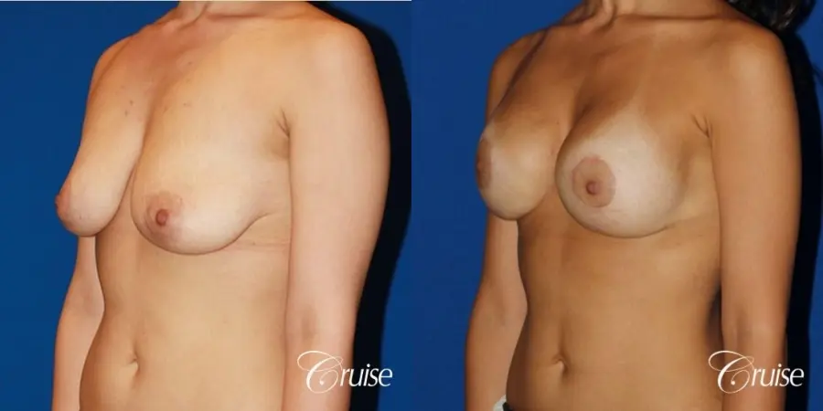 breast lift anchor with saline implants on young girl - Before and After 2
