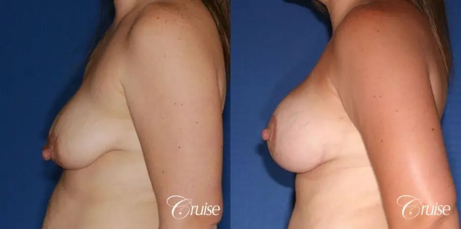 best results on young woman for breast lift anchor with saline augmentation - Before and After 2