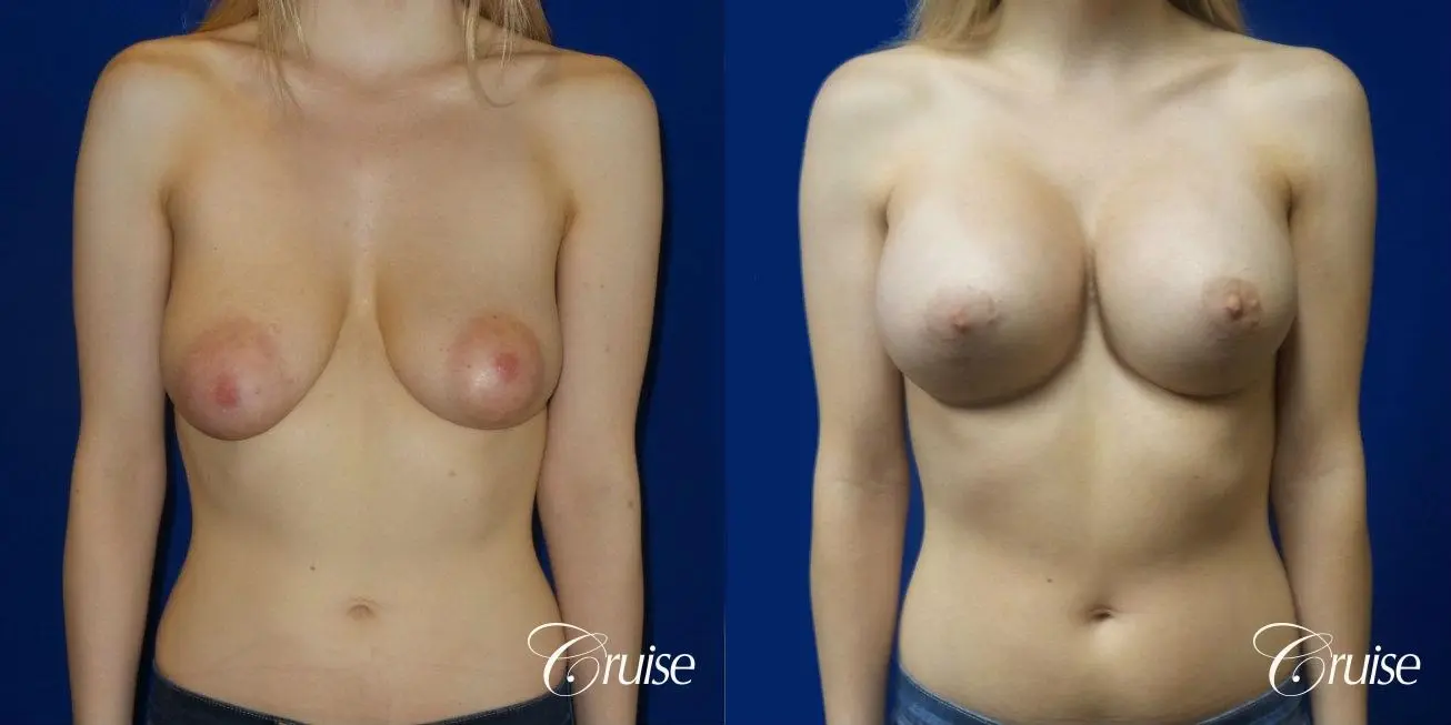 Breast Lift before and after Orange County - Before and After