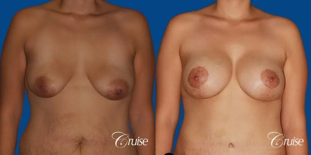 best breast lift anchor by top plastic surgeon in Newport Beach - Before and After 1