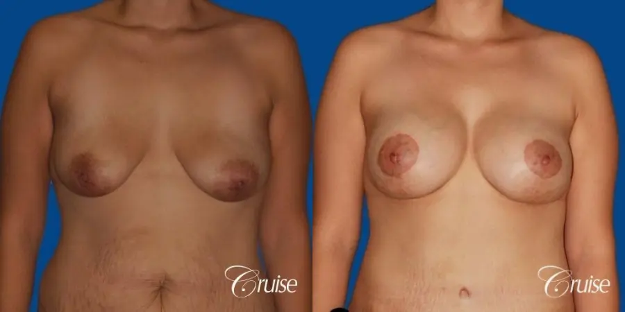 best breast lift anchor by top plastic surgeon in Newport Beach - Before and After 1