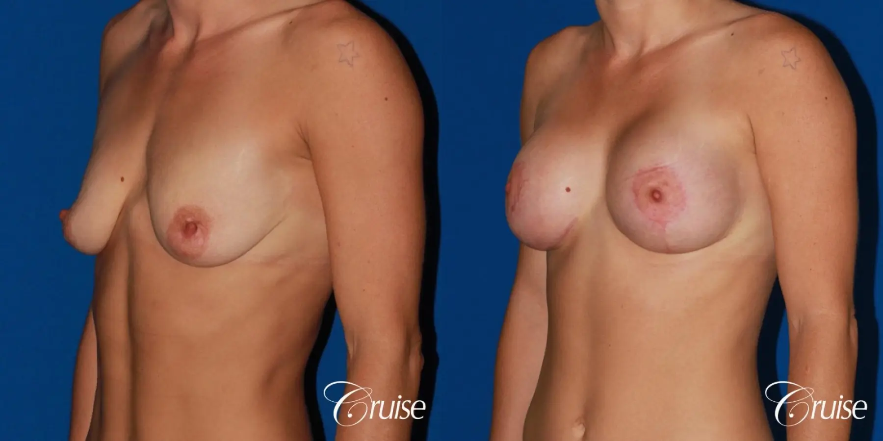 best pictures of young patients with silicone breast lift anchor - Before and After 3