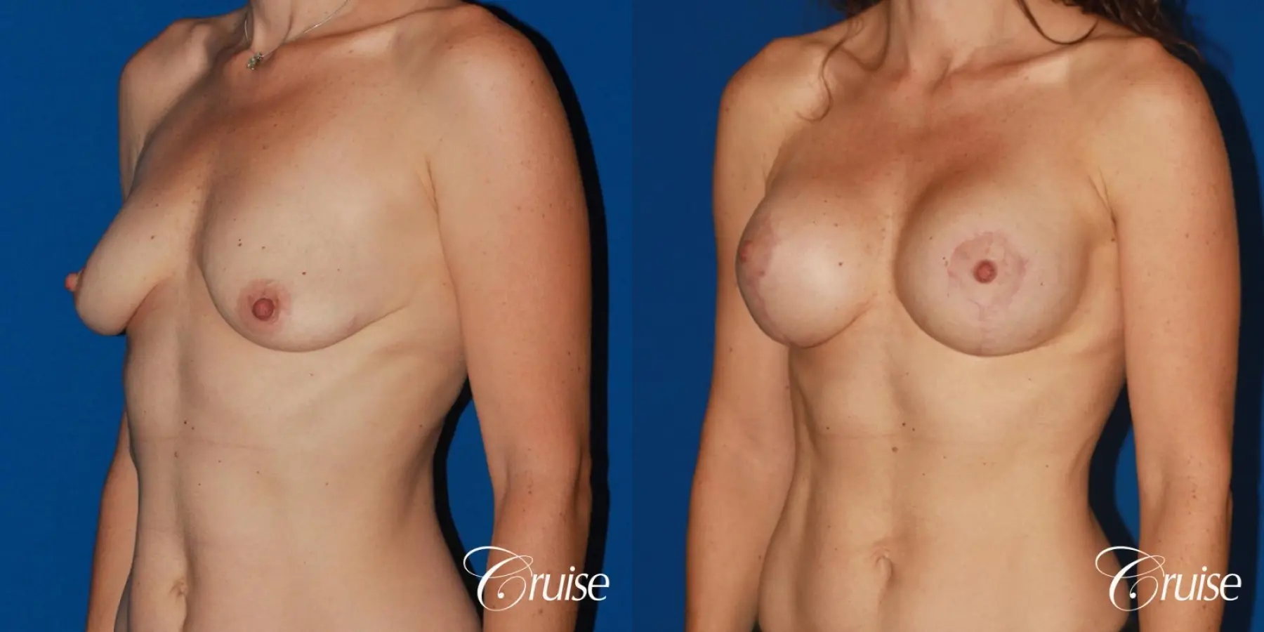 young woman with silicone breast lift anchor - Before and After 3