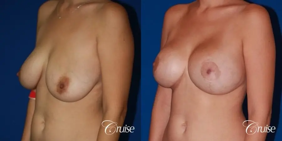 best results for breast lift anchor with saline implanta - Before and After 3