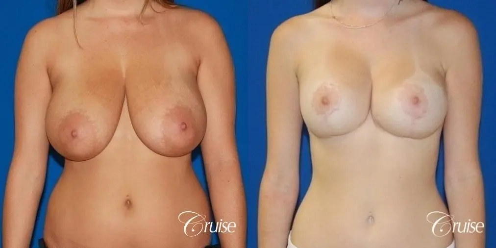 best breast lift and reduction with small saline implants - Before and After 1