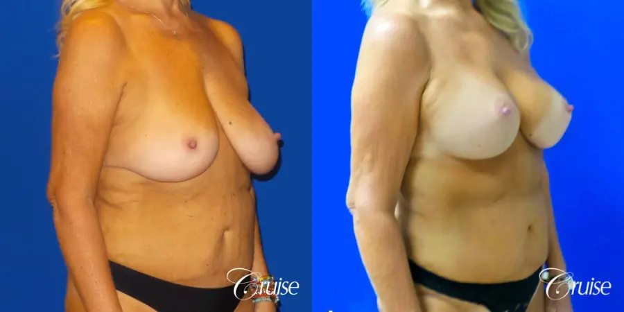 Breast Lift Anchor W/ Silicone Implants On Mature Woman - Before and After 2