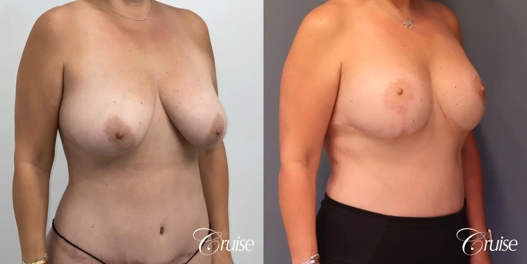 Breast Lift And Augmentation: Patient 76 - Before and After 4