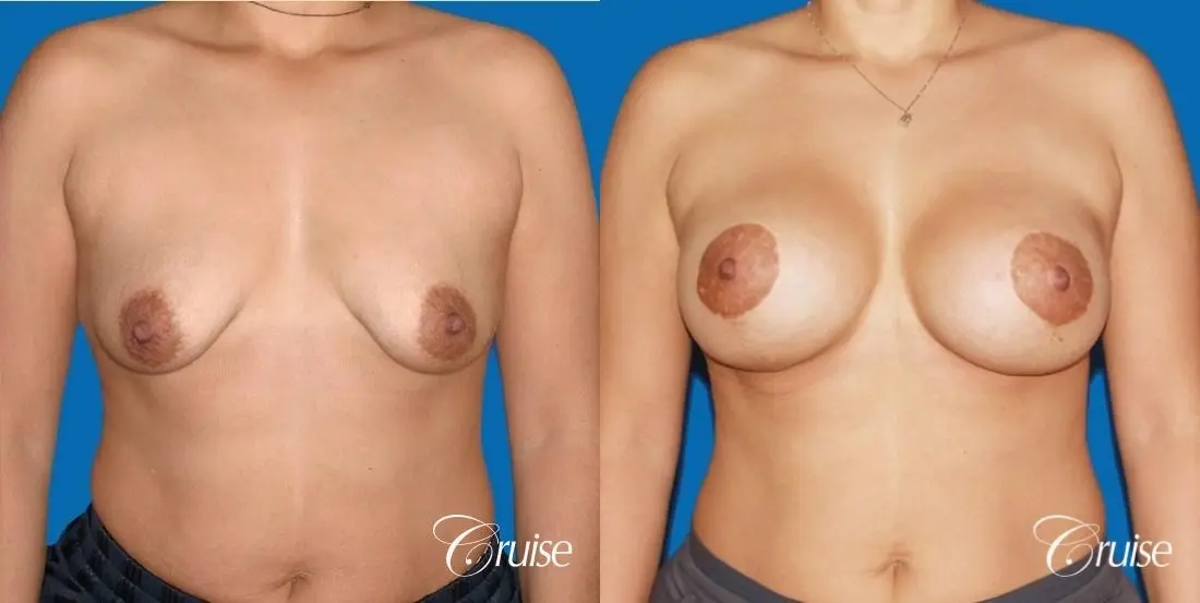 best before and after photos of young breast lift anchor scars - Before and After 1