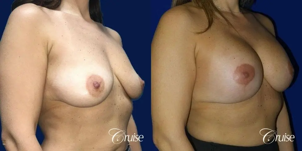 Breast Lift Anchor W/ Silicone Implants On Young Woman - Before and After 3