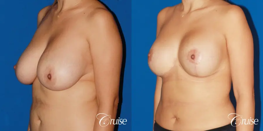 revision breast lift anchor with saline implants - Before and After 3