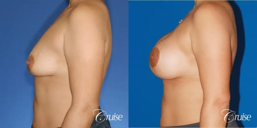 best before and after photos of young breast lift anchor scars - Before and After 2