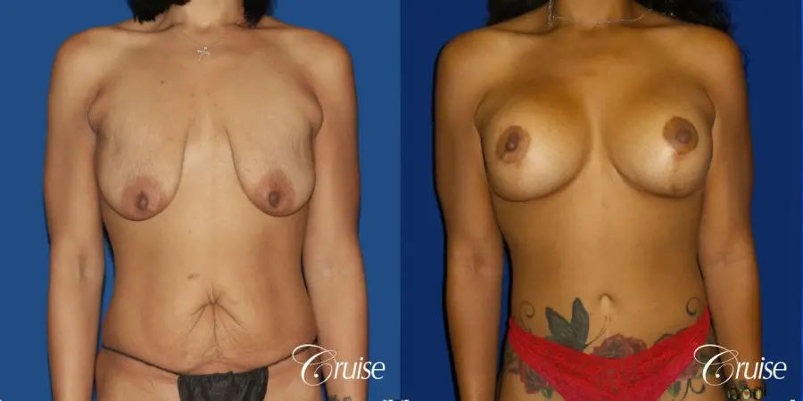 Breast Lift Anchor W/ Silicone Implants On Young Woman - Before and After 1