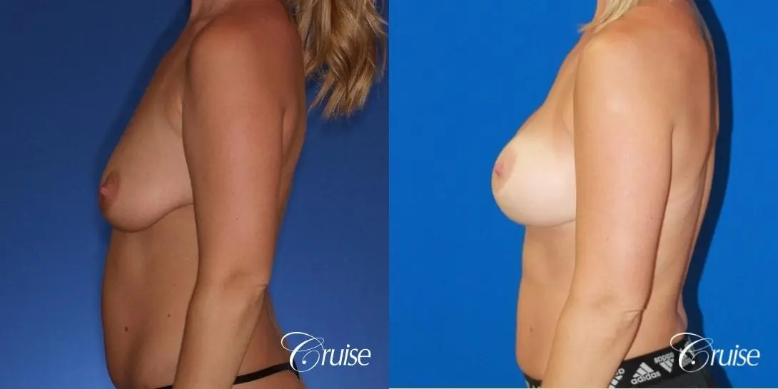 best before and after of breast lift anchor with high profile saline augmentation - Before and After 2