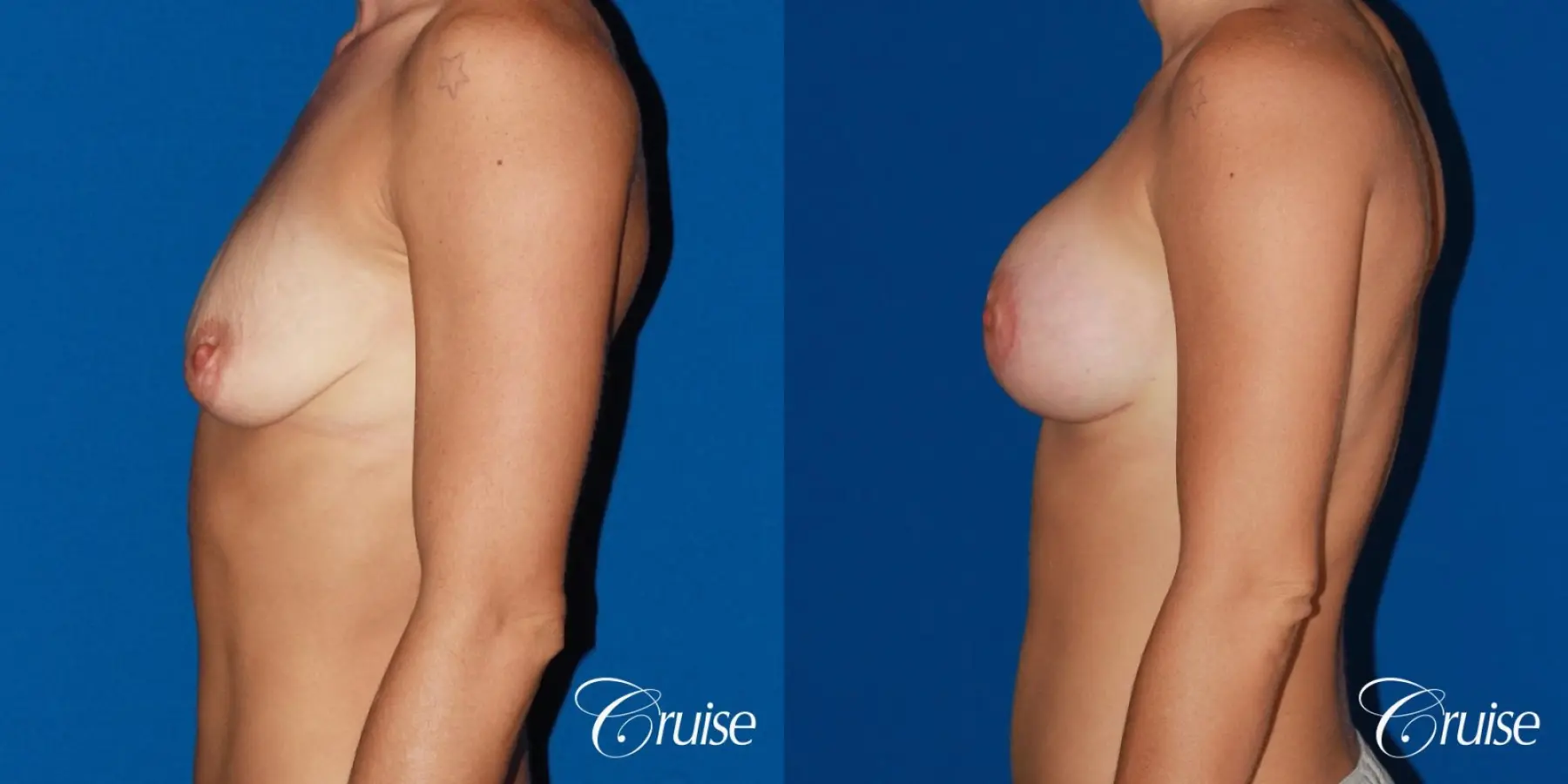 best pictures of young patients with silicone breast lift anchor - Before and After 2
