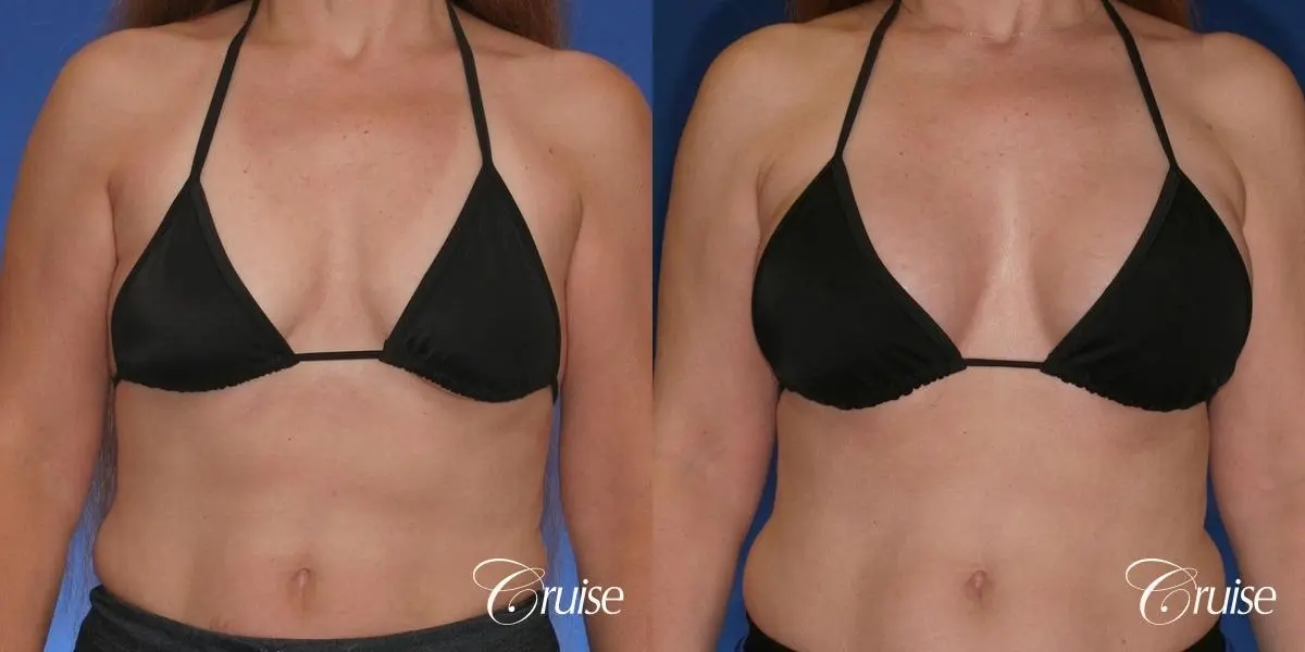 best breast lift donut scars in Newport Beach - Before and After 3