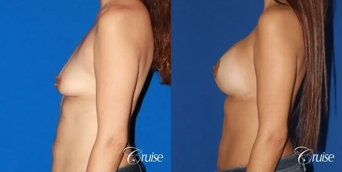best breast lift anchor with high profile silicone 425cc - Before and After 2