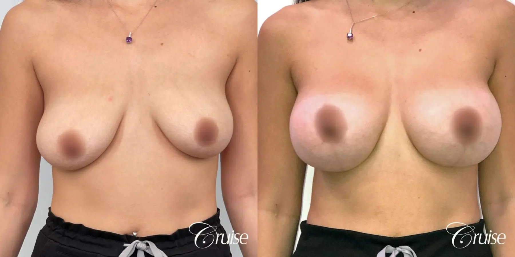 Mommy Breast Lift & Augmentation - Before and After 1
