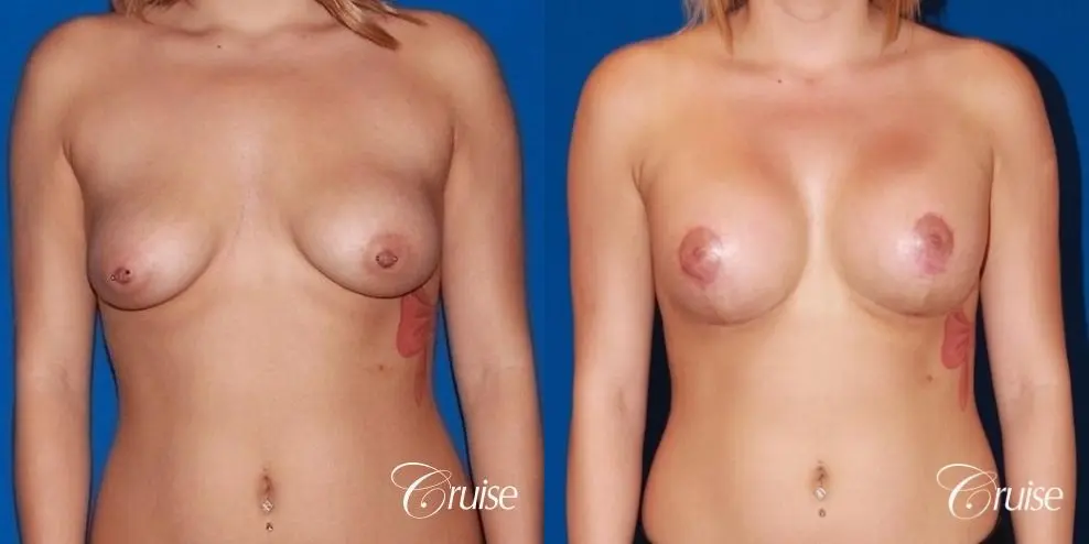 best breast lift scars on young girl with saline implants - Before and After 1