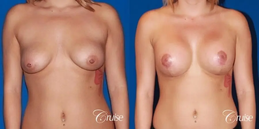 best breast lift scars on young girl with saline implants - Before and After 1