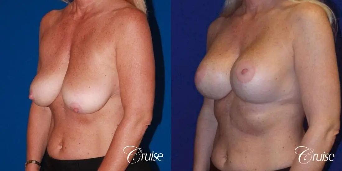 Breast Lift - Saline Augmentation - Before and After 2