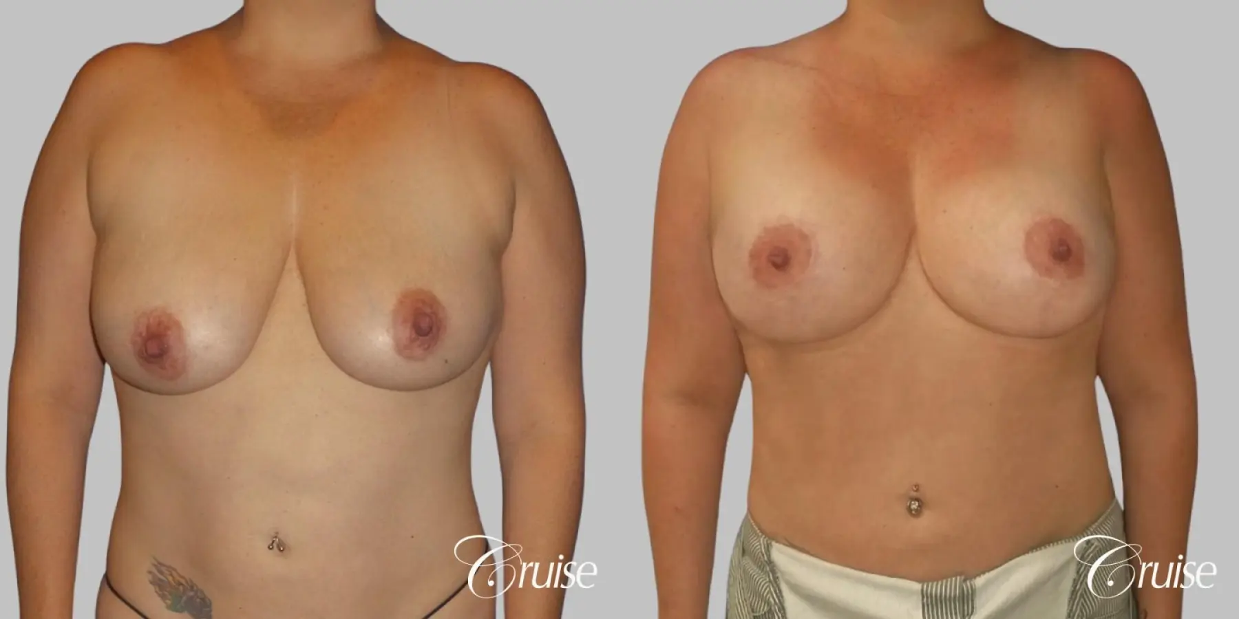 Breast Lift And Augmentation: Patient 3 - Before and After 1