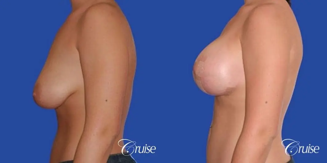 best before and after of silicone breast lift anchor in Newport Beach - Before and After 3