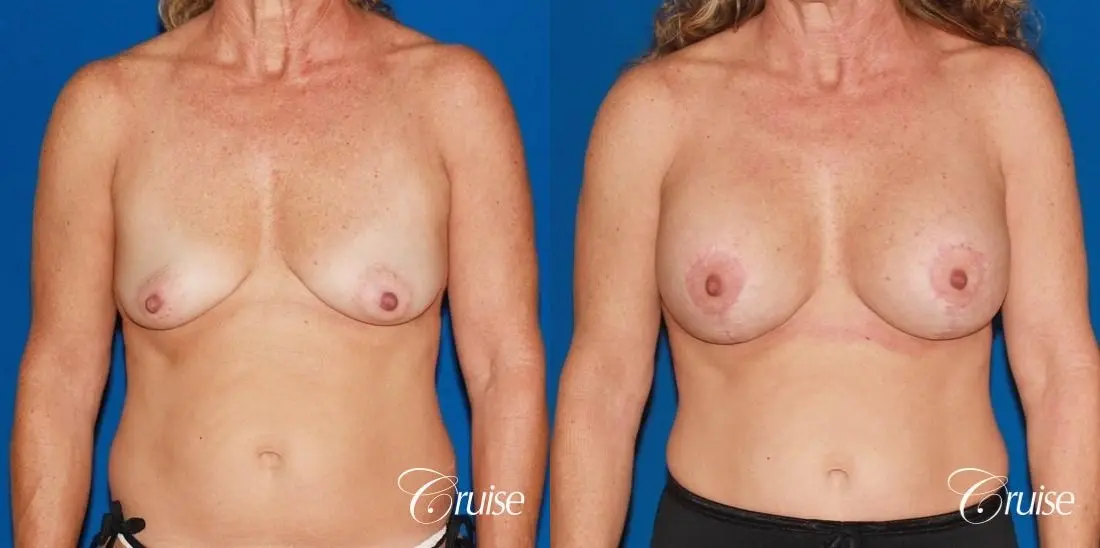 best high profile silicone breast lift 425cc - Before and After 1