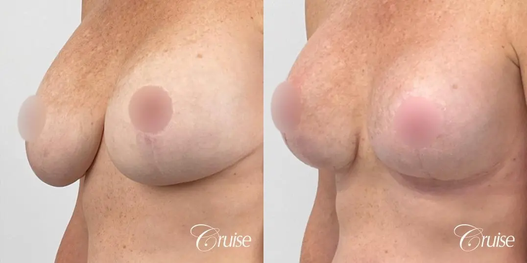Breast Lift And Augmentation: Patient 72 - Before and After 2