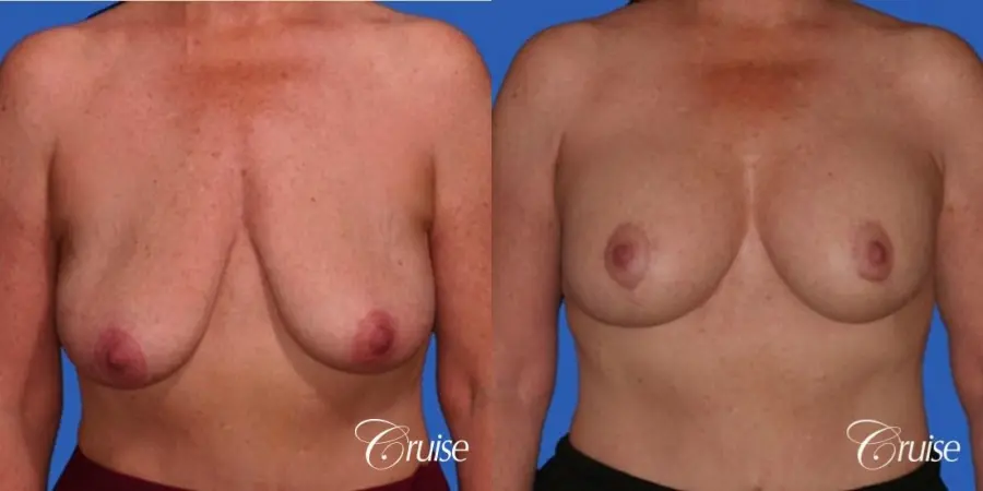 best breast lift anchor with saline augmentation - Before and After 1