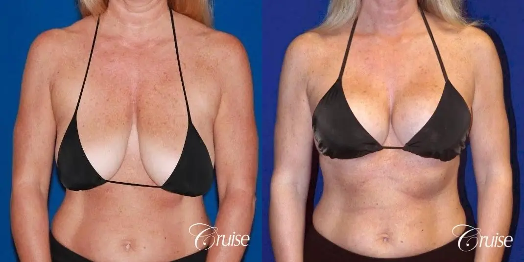Breast Lift - Saline Augmentation - Before and After 4