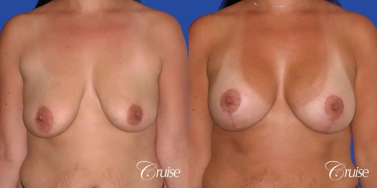 best scars on saline breast lift with top plastic surgeon in Newport Beach - Before and After 1
