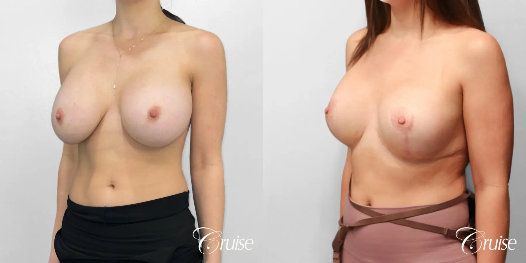 Breast Lift And Augmentation: Patient 75 - Before and After 2