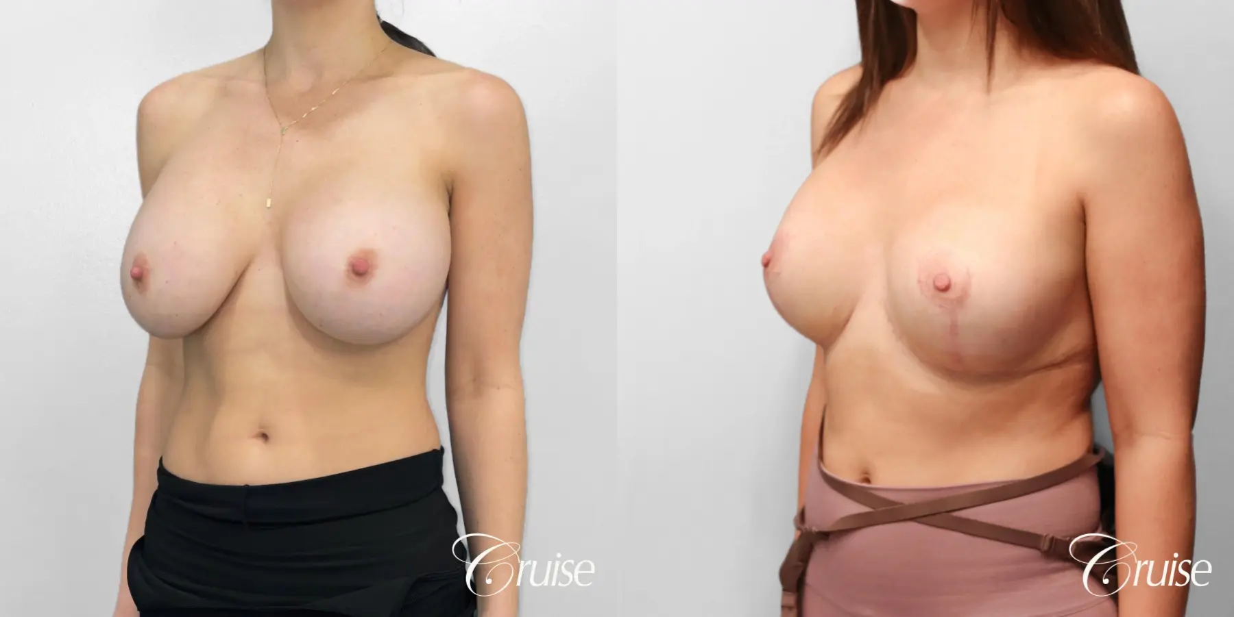 Breast Lift And Augmentation: Patient 77 - Before and After 2
