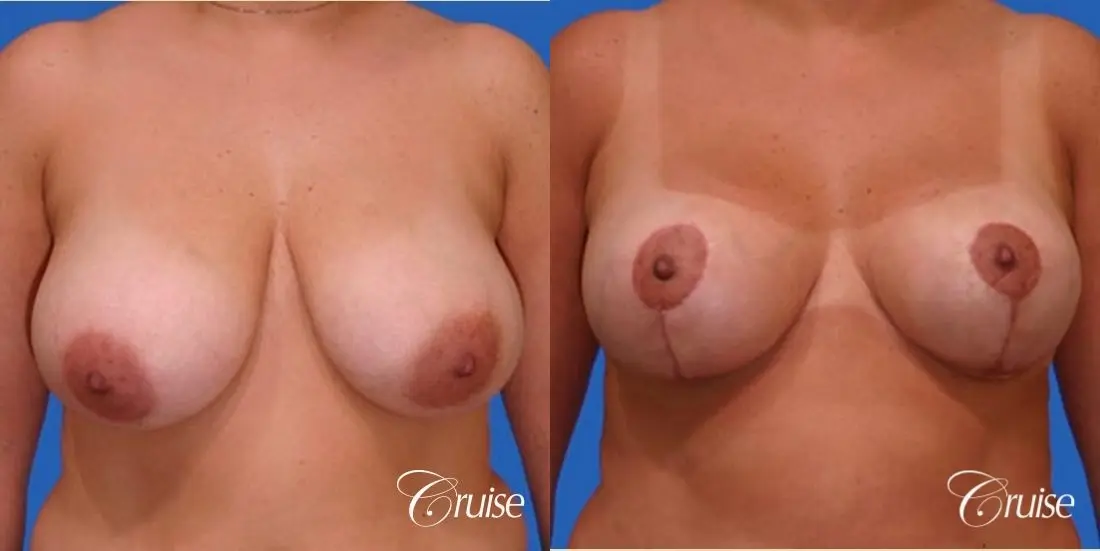 before and after pictures of saline breast lift - Before and After 1