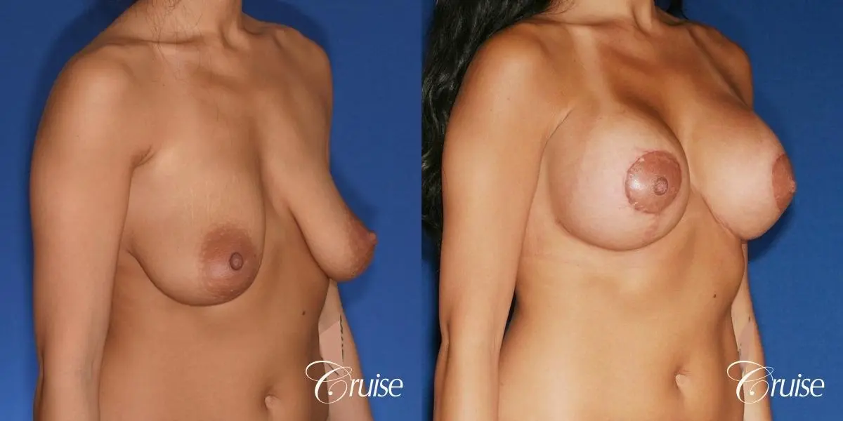 best breast lift anchor with silicone augmentation in Orange County - Before and After 3