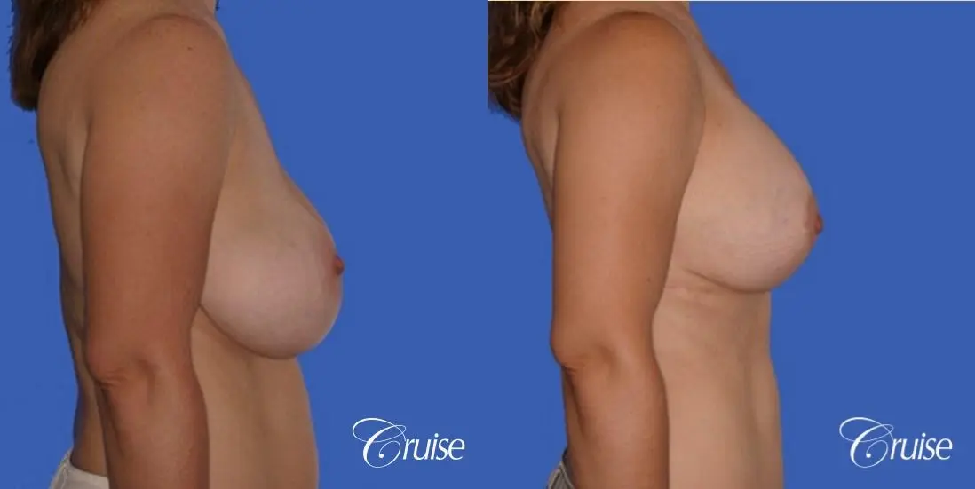 pictures of 42 yr old with breast lift anchor revision - Before and After 3