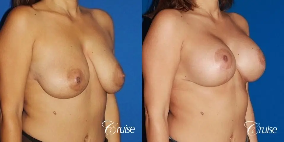 best saline breast lift with 470cc implants - Before and After 3