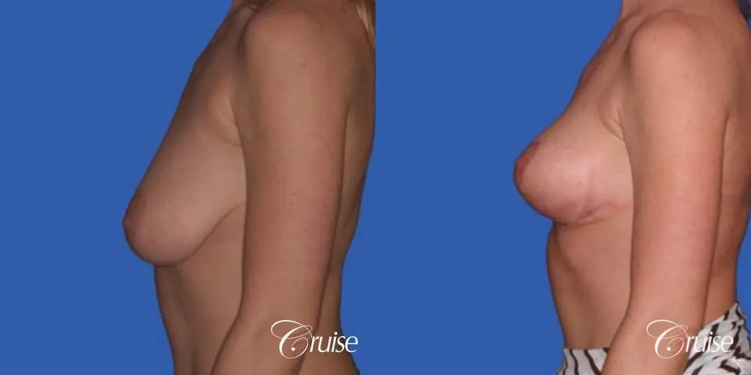 no implants with breast lift anchor - Before and After 2