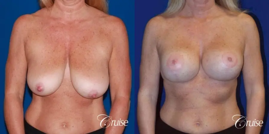 Breast Lift - Saline Augmentation - Before and After  