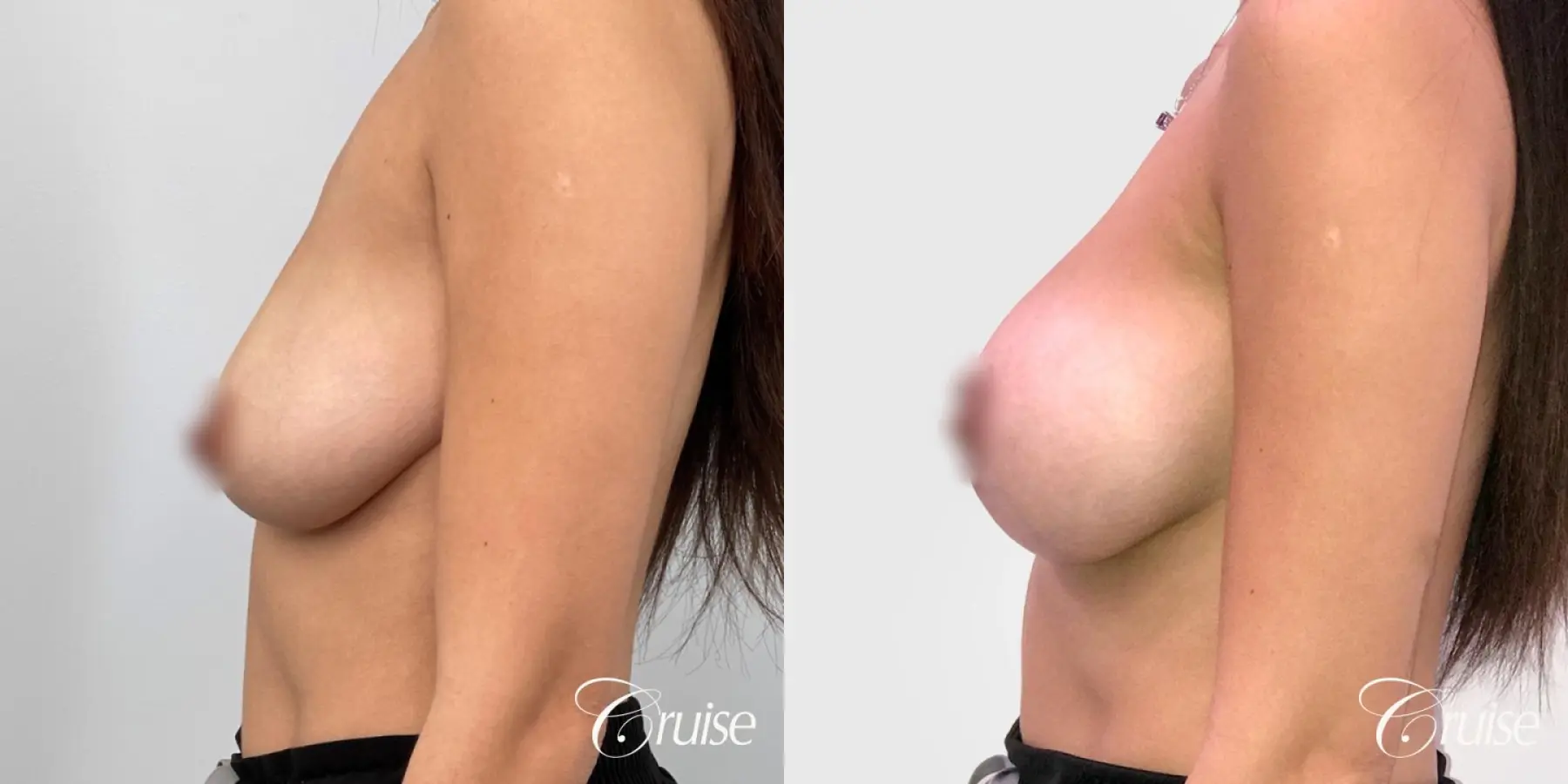 Mommy Breast Lift & Augmentation - Before and After 3