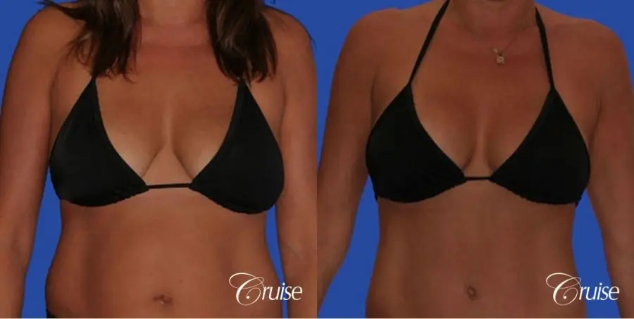 photos of best breast lift anchor with saline implants in Newport Beach - Before and After 3