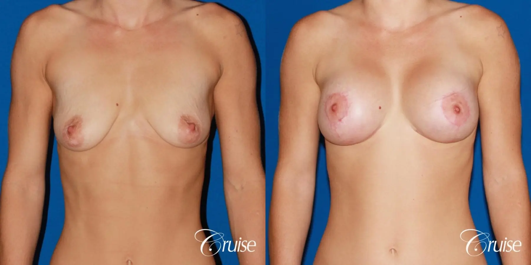 best pictures of young patients with silicone breast lift anchor - Before and After 1