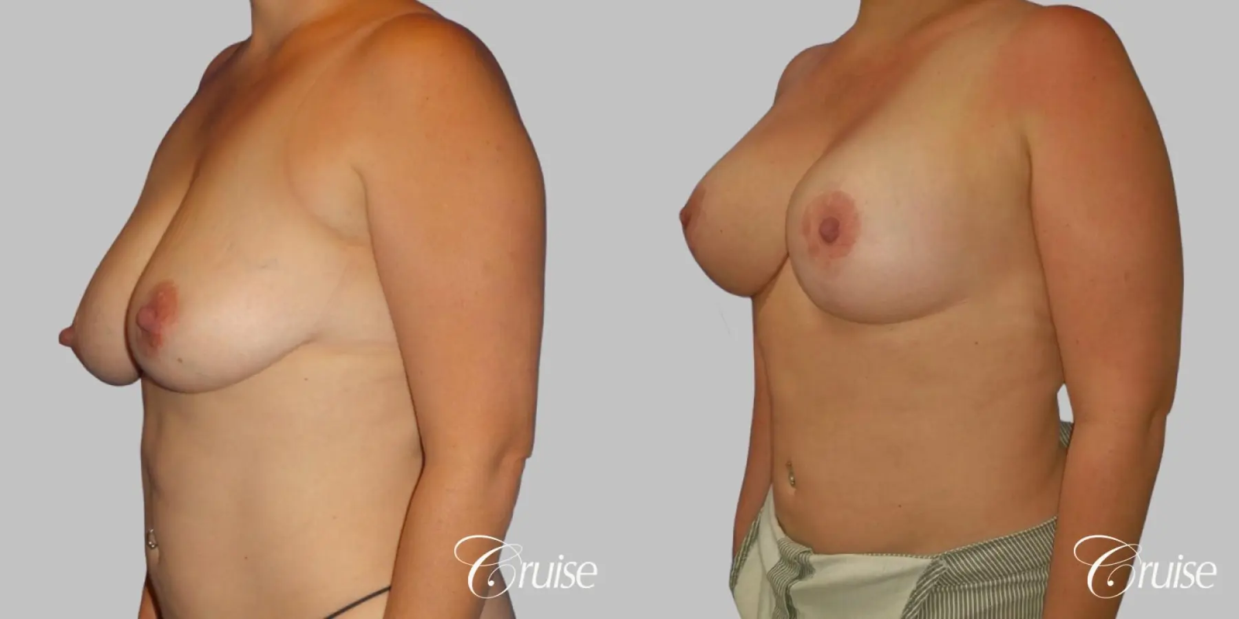Breast Lift And Augmentation: Patient 3 - Before and After 3