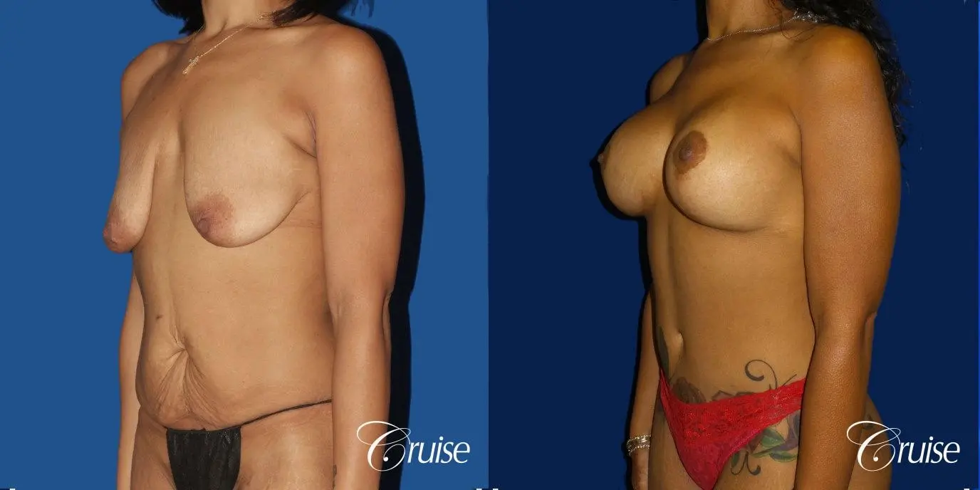 Breast Lift Anchor W/ Silicone Implants On Young Woman - Before and After 2