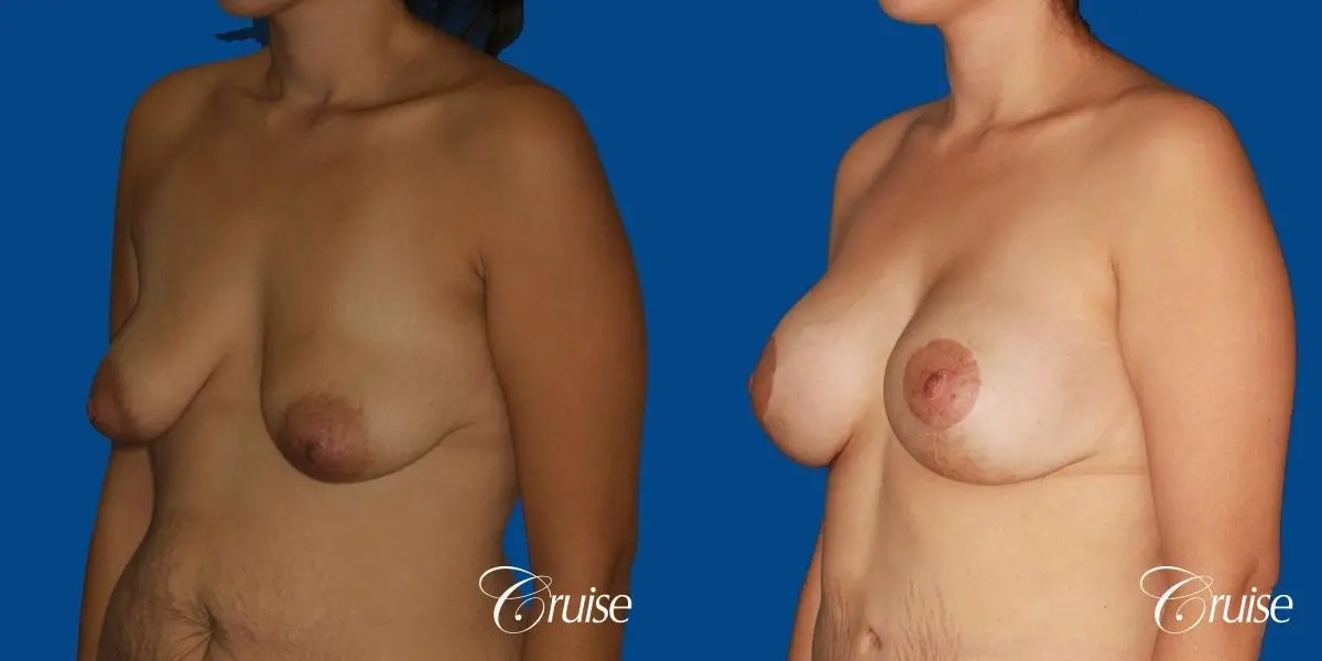 best breast lift anchor with saline augmentation - Before and After 3